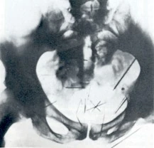 Pelvic X-ray of Albert Fish showing embedded sewing needles, 1935 trial exhibit
